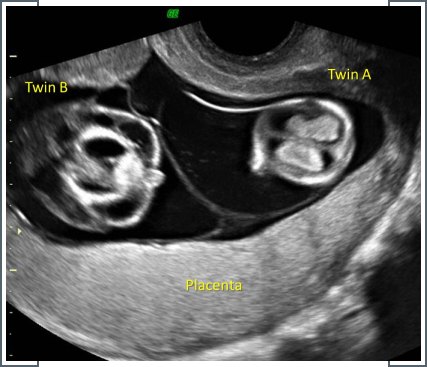 Müllerian anomalies